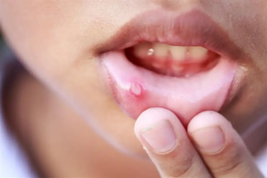 احذر.. مشروبات شائعة تسبب سرطان الفم: ما هي؟